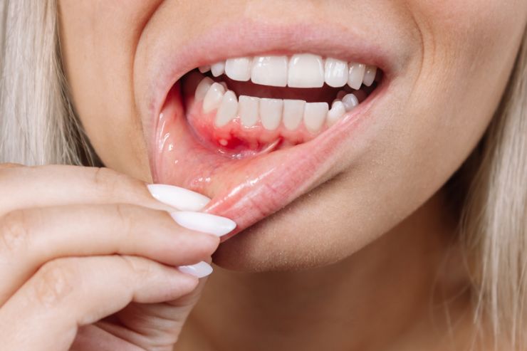 Gum Disease Treatment,