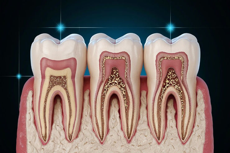 Root canals